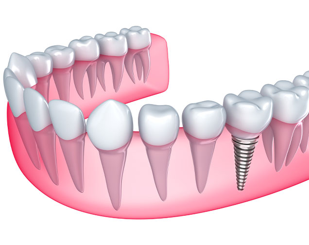 Benefits of dental implants | Kelowna General & Family Dentist | Brookside Dental Centre | Kelowna, BC