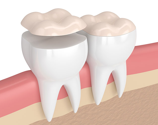 Benefits of Inlays and Onlays | Kelowna General & Family Dentist | Brookside Dental Centre | Kelowna, BC