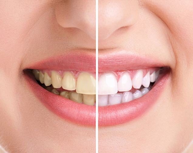 Teeth Whitening Needs | Kelowna General & Family Dentist | Brookside Dental Centre | Kelowna, BC