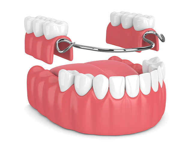 What are Partial Dentures | Kelowna General & Family Dentist | Brookside Dental Centre | Kelowna, BC