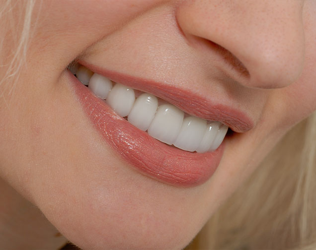 Porcelain Veneers | Kelowna General & Family Dentist | Brookside Dental Centre | Kelowna, BC