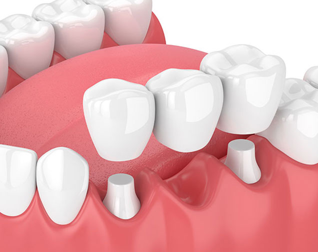 What is a Dental Bridge | Kelowna General & Family Dentist | Brookside Dental Centre | Kelowna, BC