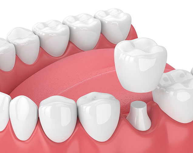 What is a Dental Crown | Kelowna General & Family Dentist | Brookside Dental Centre