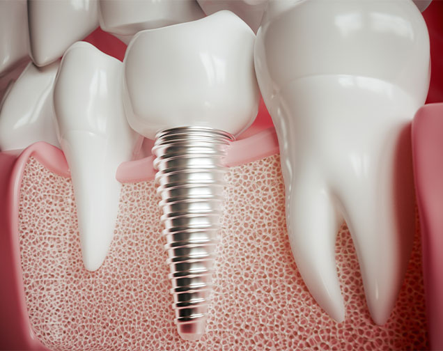 What s a Dental Implant | Kelowna General & Family Dentist | Brookside Dental Centre | Kelowna, BC