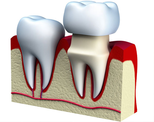 What is restorative dentistry | Kelowna General & Family Dentist | Brookside Dental Centre | Kelowna, BC