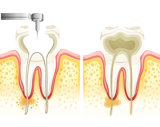 What is Root Canal Therapy | Brookside Dental Centre | Kelowna, BC