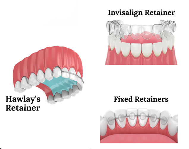 Retainers | Kelowna General & Family Dentist | Brookside Dental Centre | Kelowna, BC